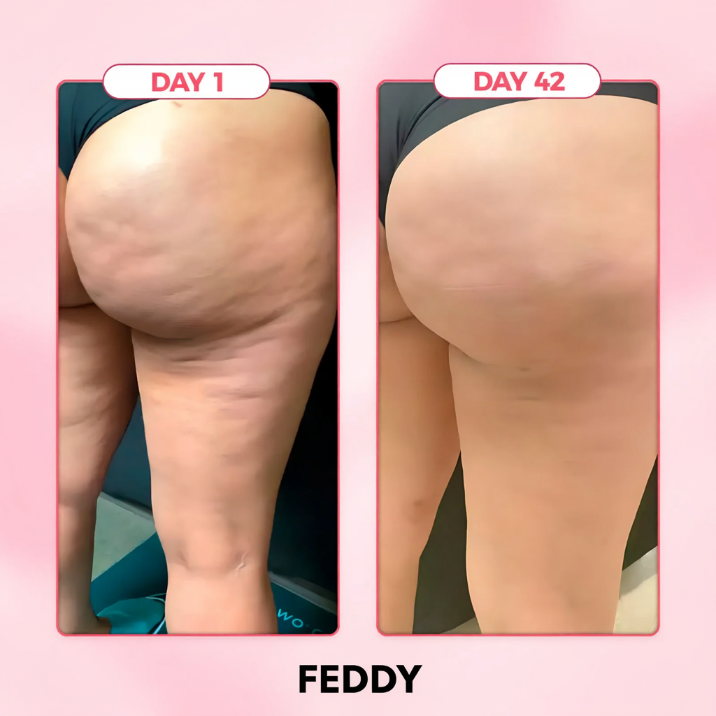 FEDDY™ Cellulite Relief Kit